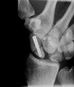 Acutrak screw in a scaphoid fracture