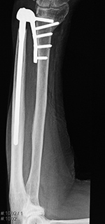Left wrist DRUJ prosthesis