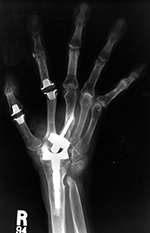 Second generation total wrist arthroplasty