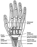 Wrist arthroplasty components