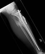 Follow-up tibia fracture.  Patient ambulating against advice. 