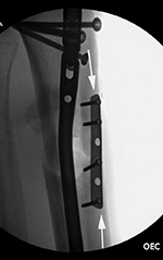 Tibia fracture fixation with IM nail and supplemental plate and screws.  Lateral view