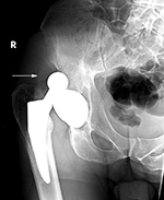 Right hip dislocation with dislocated liner