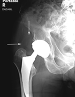 Right hip dislocation with liner displacement