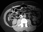 Fishooks impacted in duodenum - CT