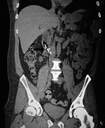 Fishooks impacted in duodenum - CT