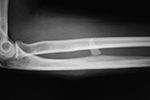Glass in forearm