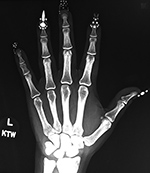 Artificial fingernails