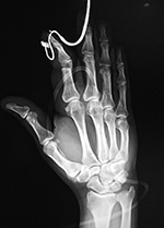 Pulse oximeter on injured right index finger
