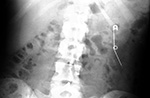 Open saftey pin in bowel