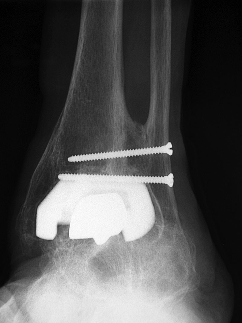 Joint Arthroplasty: a gallery