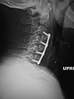 Anterior cervical fusion plate - lateral view