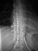Thoracic spine neurostimulator leads AP view