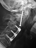 Odontoid screw lateral view