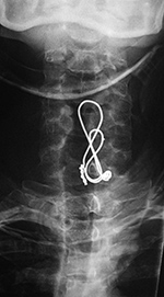 Posterior figure of 8 cervical wire