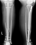 Rush pin and tibial nail
