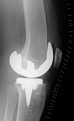 Cruciate retaining total knee prosthesis - lateral view 