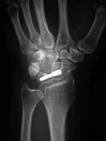 Flexible wrist screw