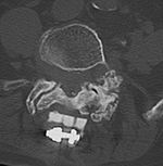 IFIF axial CT image