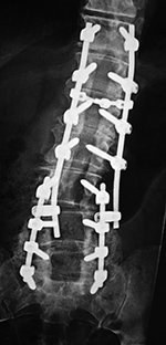 Lumbar spine pedicle screws and rods