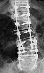 Extensive lumbar spine fixation