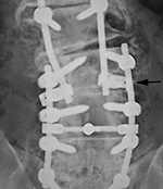 Lumbar spine interconnecting link loosening