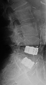 Lumbar spine disk spacers