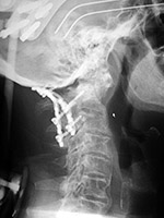 Occipital strut with posterior cervical plates