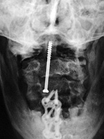Odontoid fixation screw