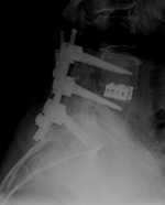 Posterior spinal fusion apparatus lateral view