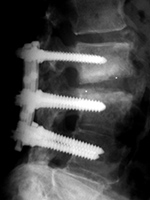 Steffee plates and screws with Brantigan intervertebral disk cages lateral view 