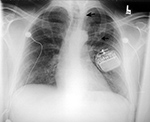 Vagus nerve stimulator AP view of the chest