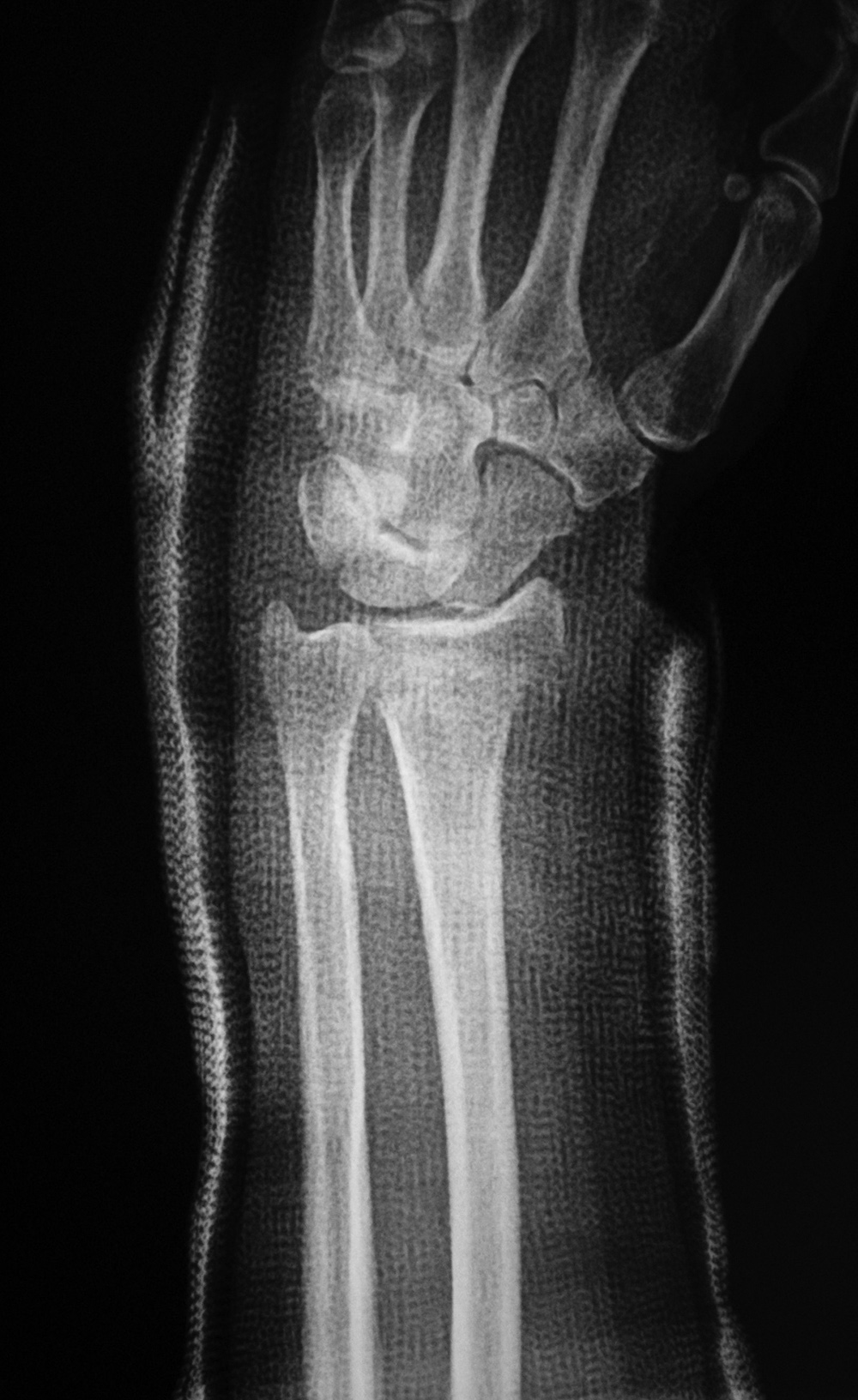 Fracture Fixation: a gallery