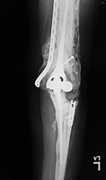 Elbow prosthesis and heterotopic bone