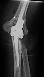 Infected left elbow prosthesis