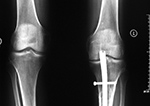Left knee antegrade intramedullary rod displacement into knee joint
