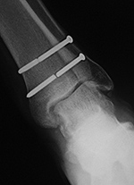 Left ankle syndesmotic screw fracturing
