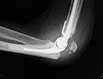 Left elbow prosthesis with olecranon periprosthetic fracture