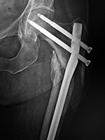 Left femur IM rod fracture