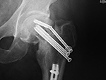 Left hip cannulated screw fracture