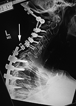 Occiput to T8 posterior spinal fixation after rod dislodgement