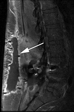 PLIF postoperative abscess sagittal MRI