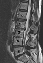 PLIF arachnoiditis MRI sagittal
