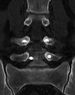 PLIF misplaced screw CT coronal