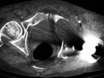 Left hip arthroplasty: polyethylene liner wear with associated osteolysis and particle disease - axial CT image