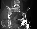 Left hip particle disease CT coronal image