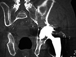Left hip arthroplasty: polyethylene liner wear with associated osteolysis and particle disease - coronal CT iamge