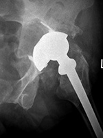 Left hip arthroplasty: polyethylene liner wear with associated osteolysis and particle disease
