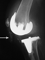 Right total knee prosthesis patellar button dislocation