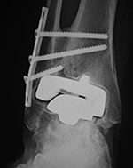 Right ankle prosthesis failure